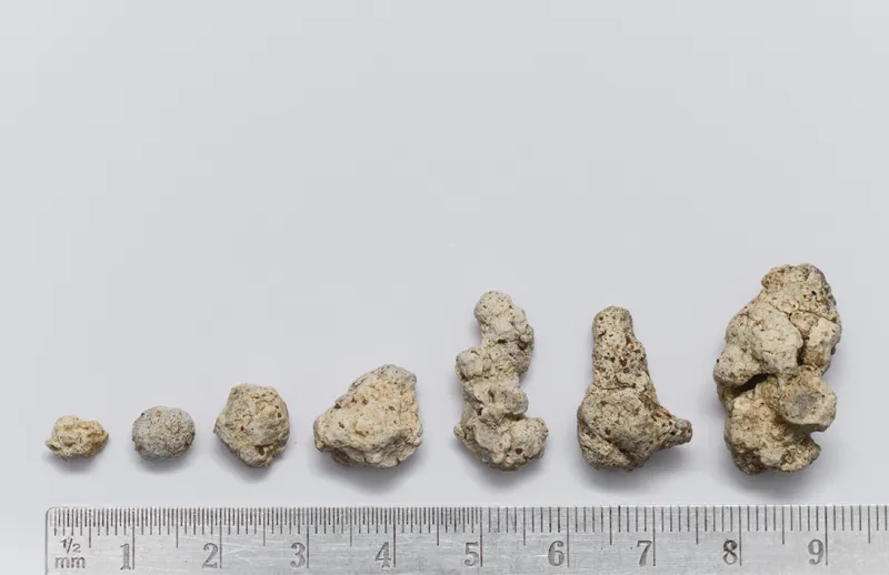 Kidney stones of different sizes arranged beside a ruler for size comparison.