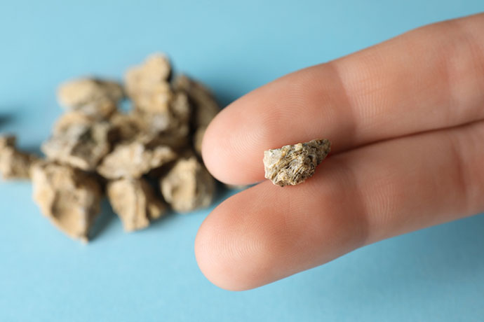 Kidney Stone Treatment Singapore
